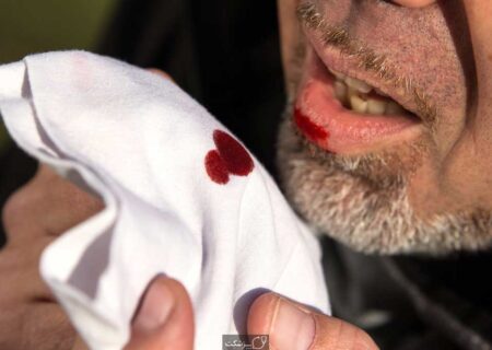  معاون بهداشتی دانشگاه علوم پزشکی ایلام: بیماری سل همچنان در استان وجود دارد و یکی از اولویت‌های بهداشتی است